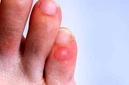 Ayak Parmağı Su Toplaması Belirtileri ve Tedavisi Ayak Parmağı Su Toplaması Belirtileri ve Tedavisi