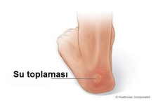 Ayak Topuğu Su Toplaması Belirtileri ve Tedavisi Ayak Topuğu Su Toplaması Belirtileri ve Tedavisi
