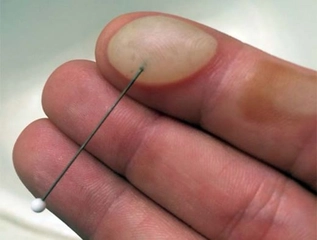 Su Toplaması Belirtileri ve Tedavisi Su Toplaması Belirtileri ve Tedavisi